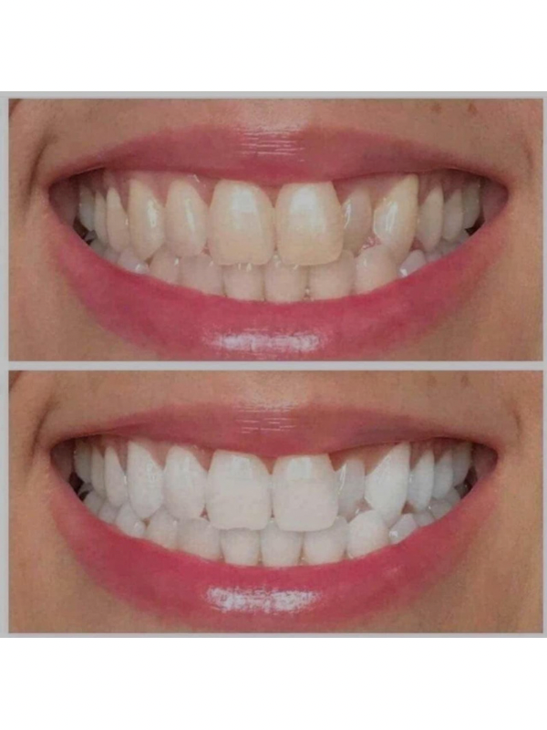 UltraViolet Pearly White Teeth Whitening Gel